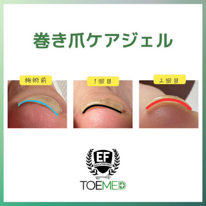 M's nail　巻き爪ケアジェル始めました♪